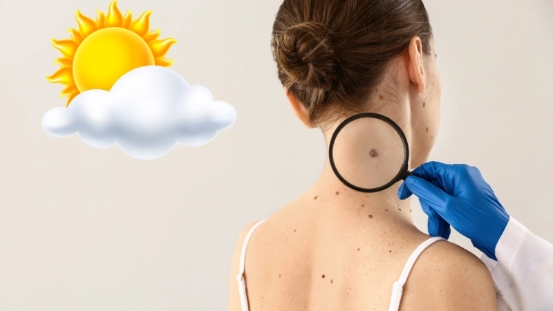 Ánh nắng mặt trời – Yếu tố ảnh hưởng đến sự hình thành nốt ruồi