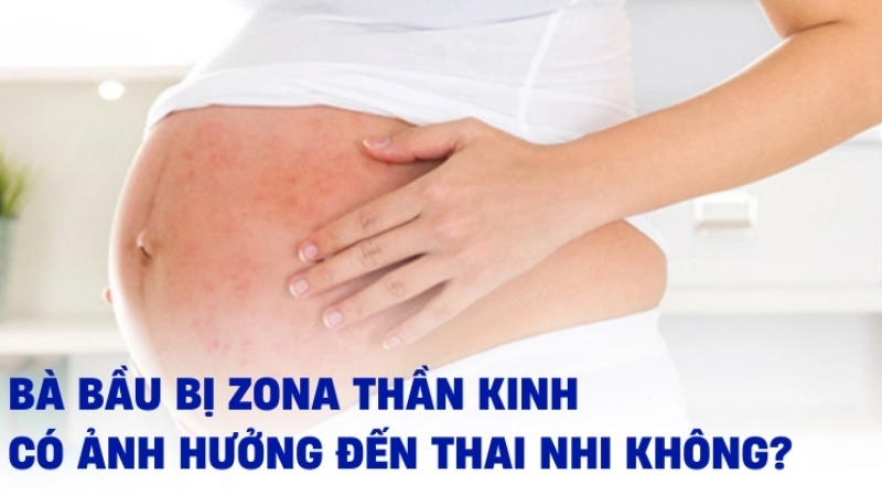 Bầu bị zona có sao không?