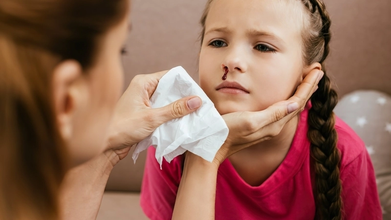 Xử lý khi trẻ bị chảy máu cam tại nhà