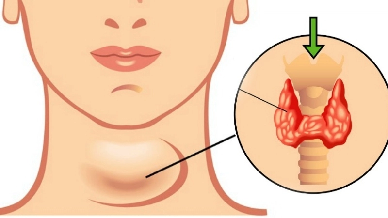 Suy giáp gây ảnh hưởng như thế nào đến sức khỏe?