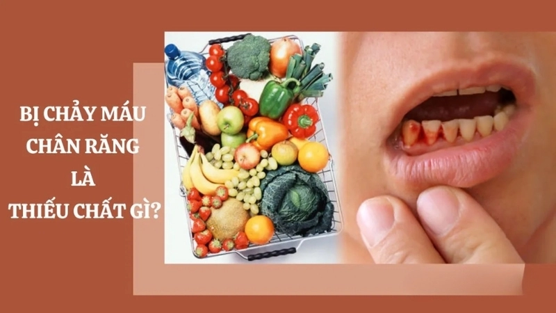 Bị chảy máu răng là thiếu chất gì?