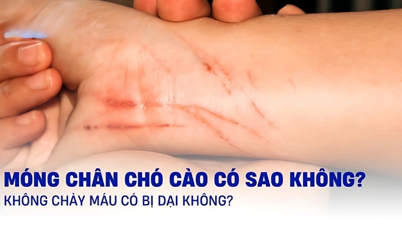 Bị chó cào có sao không?