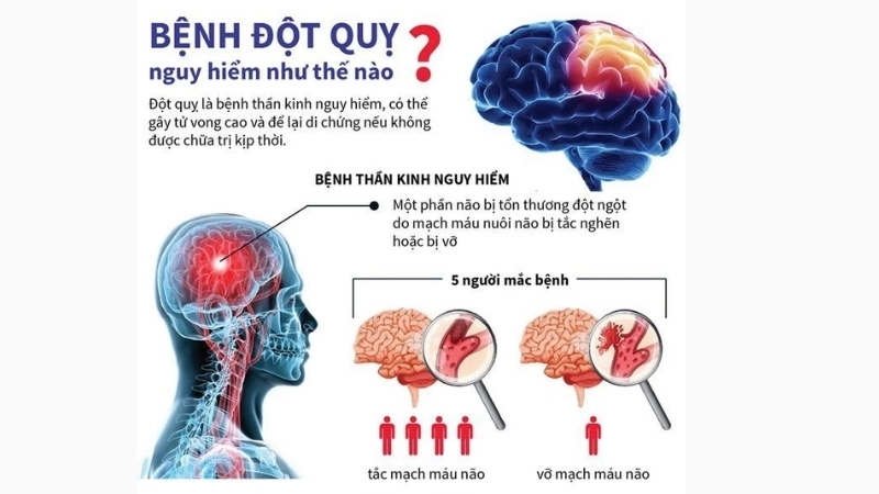 Dấu hiệu nhận biết khi bị đột quỵ