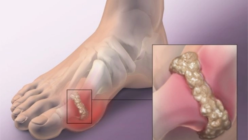 Dấu hiệu nhận biết khi bị gút