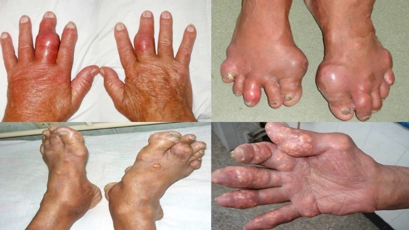 Phương pháp và mẹo chữa trị khi bị gút