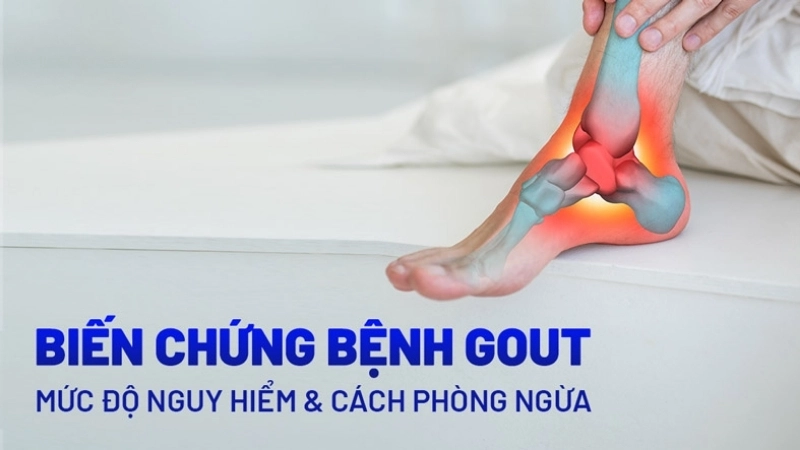 Bị gút có sao không?