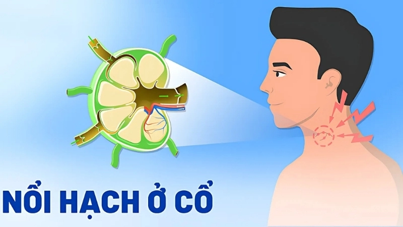 Bị hạch có sao không?