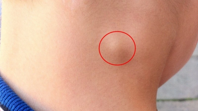 Triệu chứng khi bị hạch