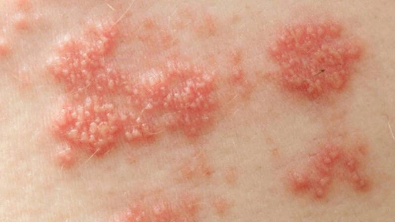 Dấu hiệu nhận biết khi bị HPV