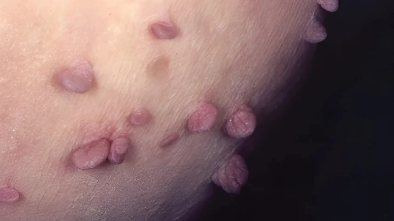 Phương pháp và mẹo chữa trị khi bị HPV