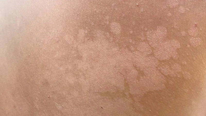 Bị lang ben có sao không?