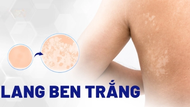 Triệu chứng khi bị lang ben