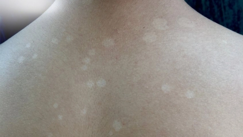 Mẹo và biện pháp chữa trị khi bị lang ben