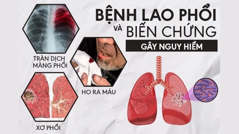 Bị lao phổi có sao không?