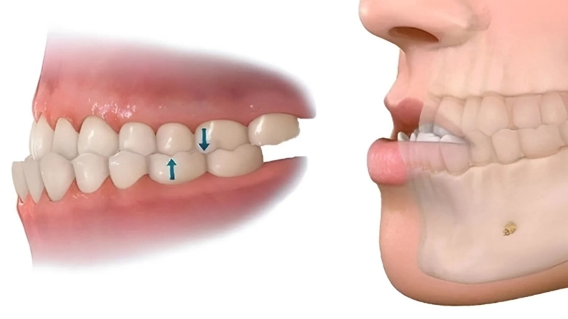 Mẹo và biện pháp chữa trị khi bị lệch hàm