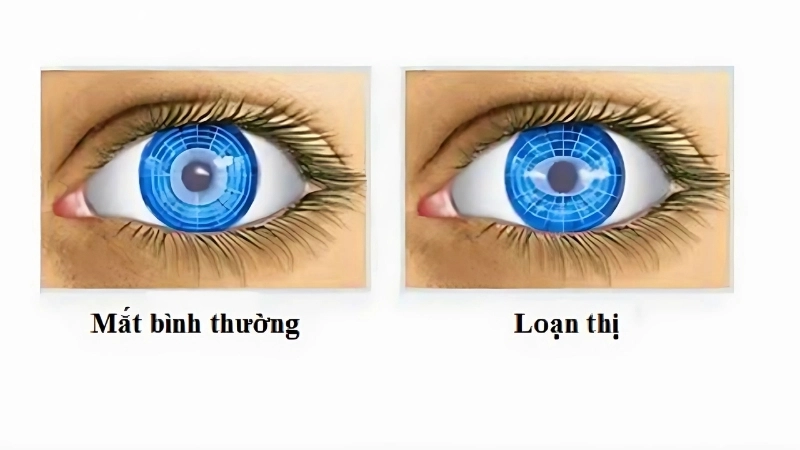 Bị loạn thị có sao không?