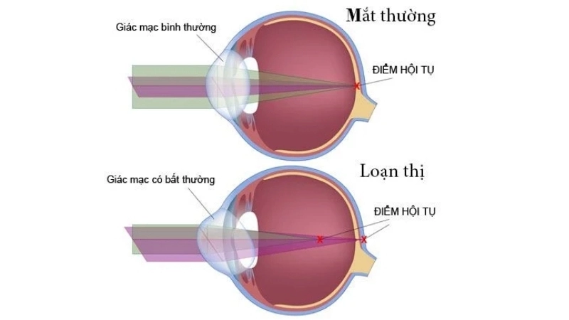Triệu chứng khi bị loạn thị