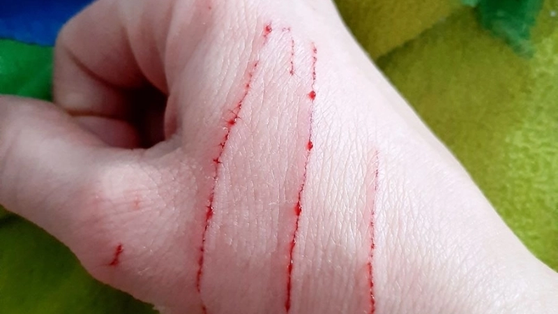 Triệu chứng khi bị mèo cắn