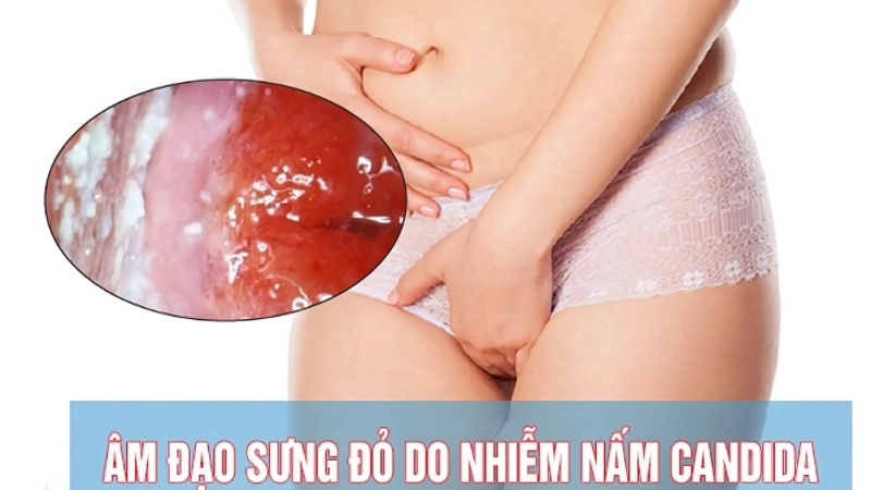 Bị nấm candida có sao không?