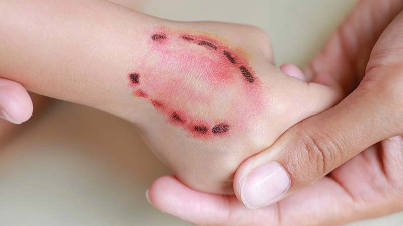 Mẹo và biện pháp chữa trị khi bị người cắn