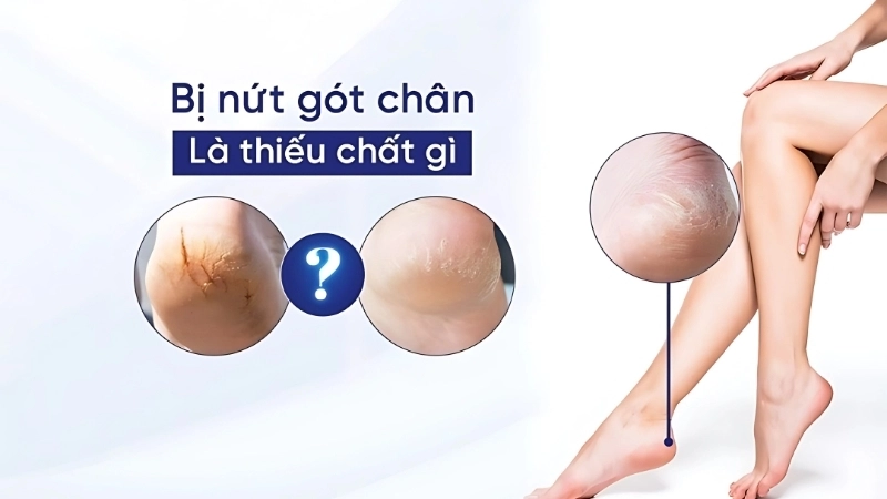 Bị nứt gót chân là thiếu chất gì?