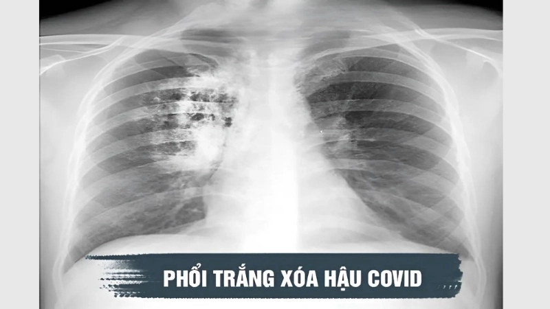 Bị phổi trắng có sao không?