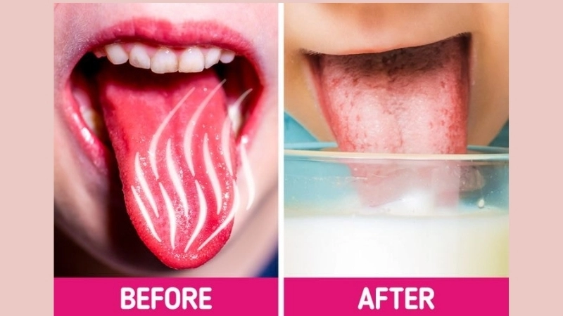 Bị phỏng lưỡi có sao không?