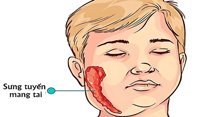 Mẹo và biện pháp chữa trị khi bị quai bị