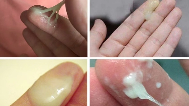 Bị ra huyết trắng nhiều có sao không?
