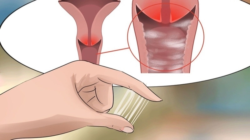 Dấu hiệu nhận biết khi bị ra huyết trắng nhiều bất thường