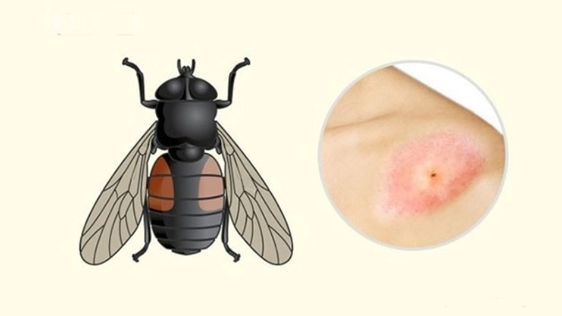 Bị ruồi cắn có sao không?