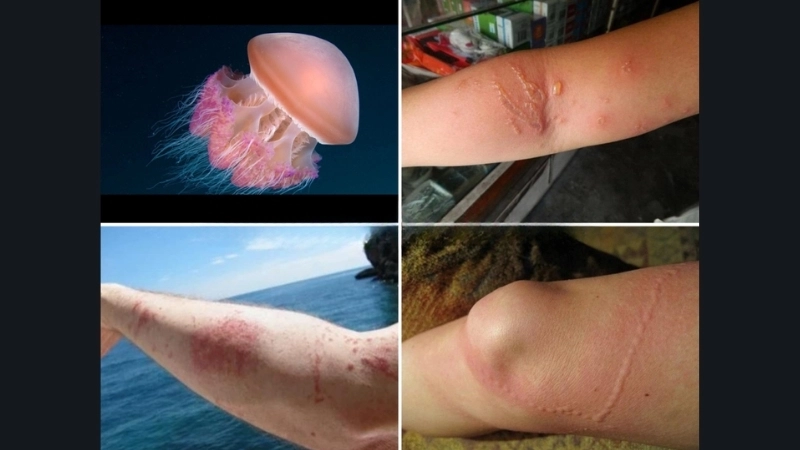 Triệu chứng khi bị sứa cắn