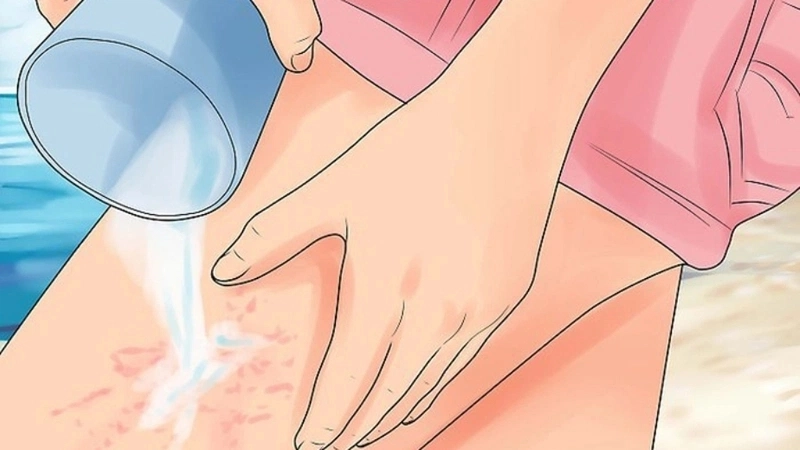 Mẹo và biện pháp chữa trị khi bị sứa cắn