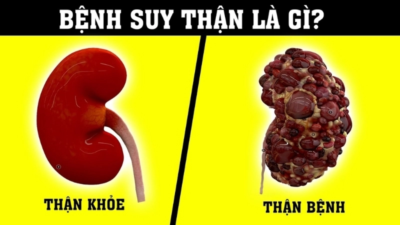 Triệu chứng khi bị suy thận