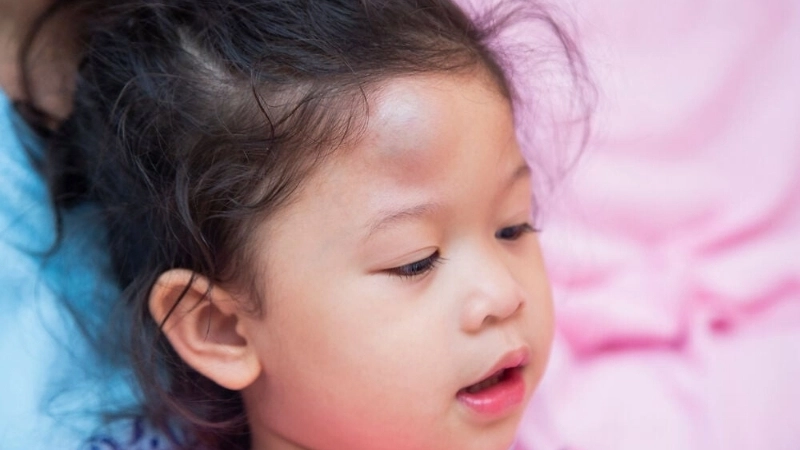 Bị u đầu có sao không?