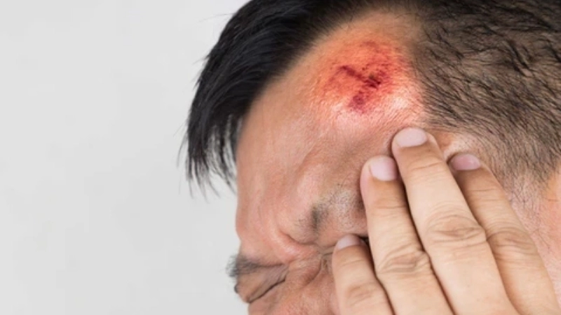 Triệu chứng khi bị u đầu