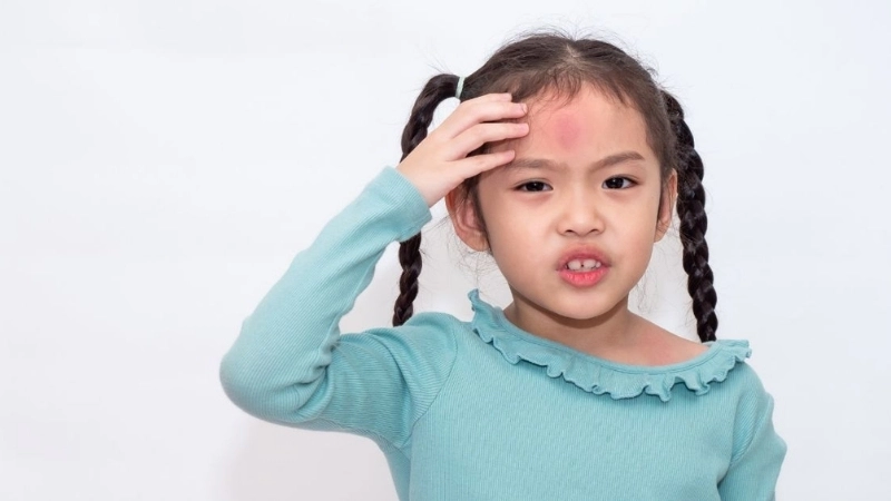 Mẹo và biện pháp chữa trị khi bị u đầu