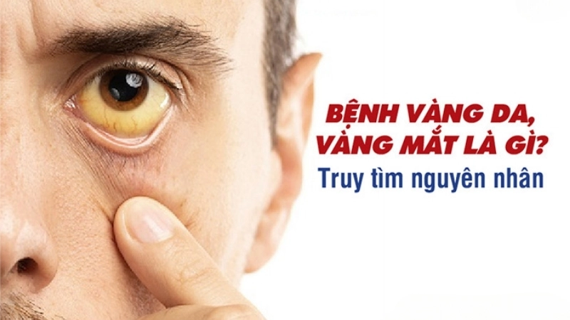 Bị vàng mắt có sao không?