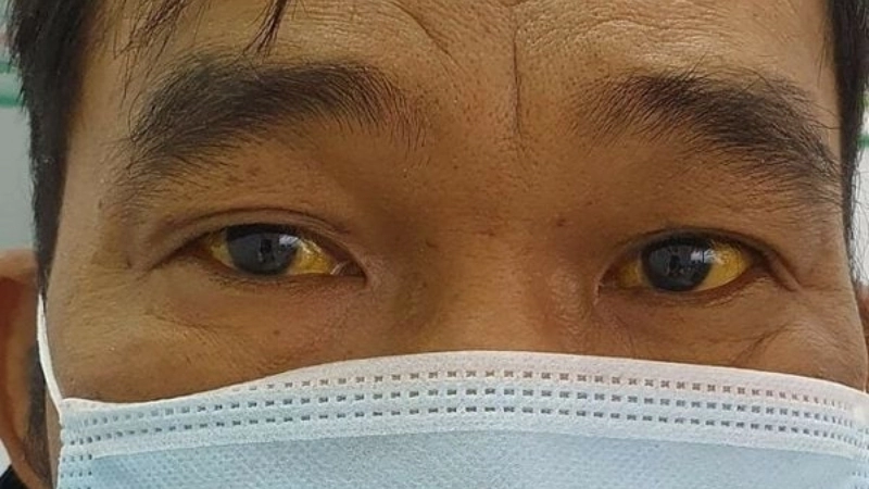 Mẹo và biện pháp chữa trị khi bị vàng mắt