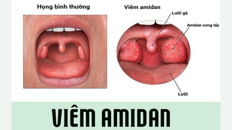 Bị viêm amidan có sao không?