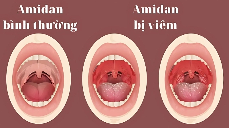 Triệu chứng khi bị viêm amidan