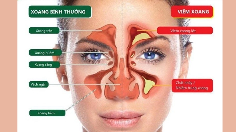 Bị viêm xoang có sao không?