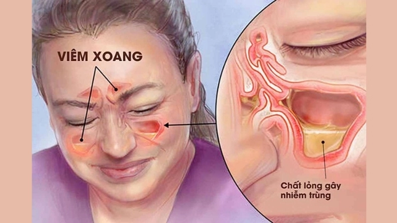 Mẹo và biện pháp chữa trị khi bị viêm xoang