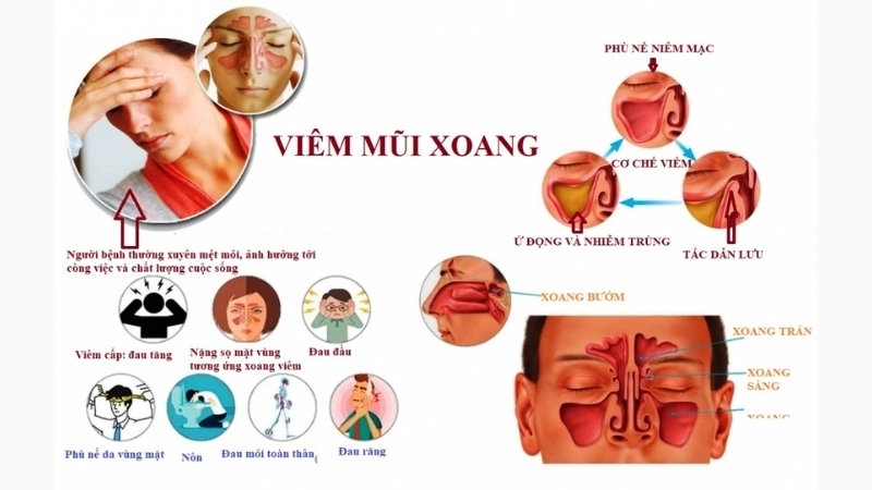 Triệu chứng khi bị viêm xoang