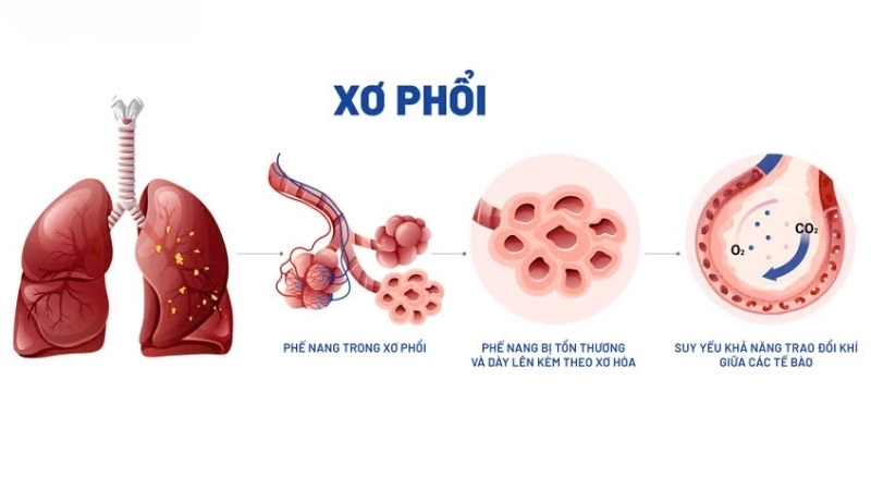 Bị xơ phổi có sao không?