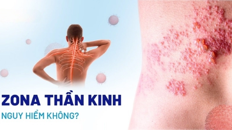 Bị zona có sao không?