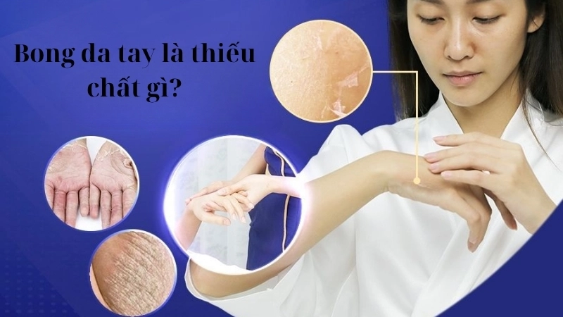 Bong da tay là thiếu chất gì?