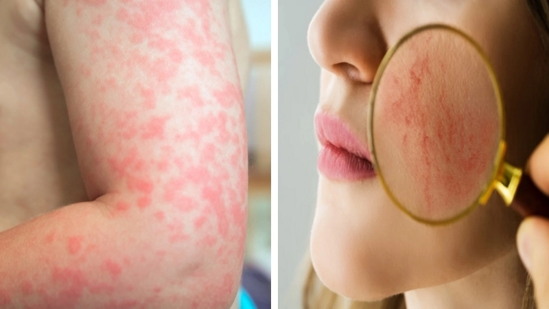Các mảng da nổi mẩn đỏ, sưng nhẹ ở vùng mặt do phản ứng với sự thay đổi của thời tiết