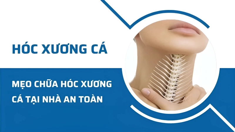7 cách chữa hóc xương cá bằng mẹo đơn giản tại nhà
