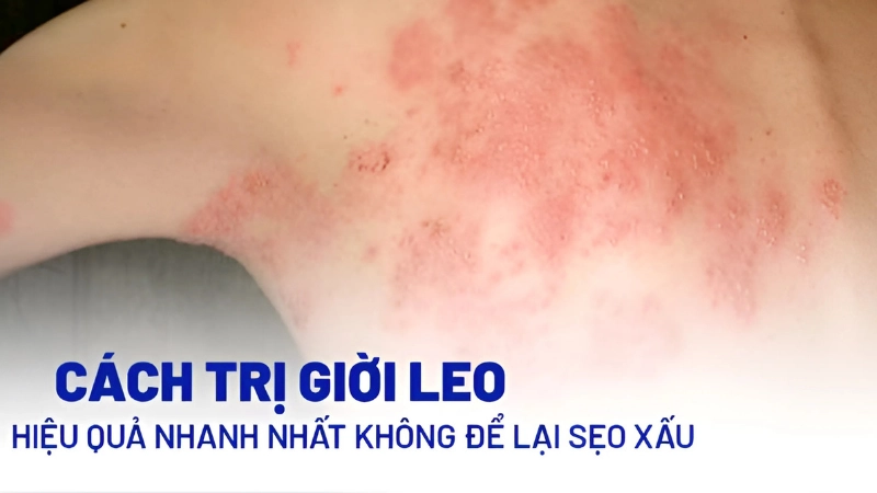 Top 5 cách chữa mẹo giời leo theo dân gian phổ biến